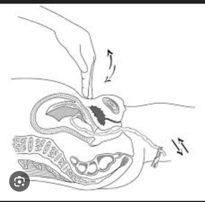 Gestion optimale de la troisième période d'accouchement (GATPA)
